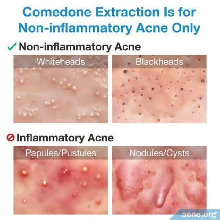 What is Comedone acne