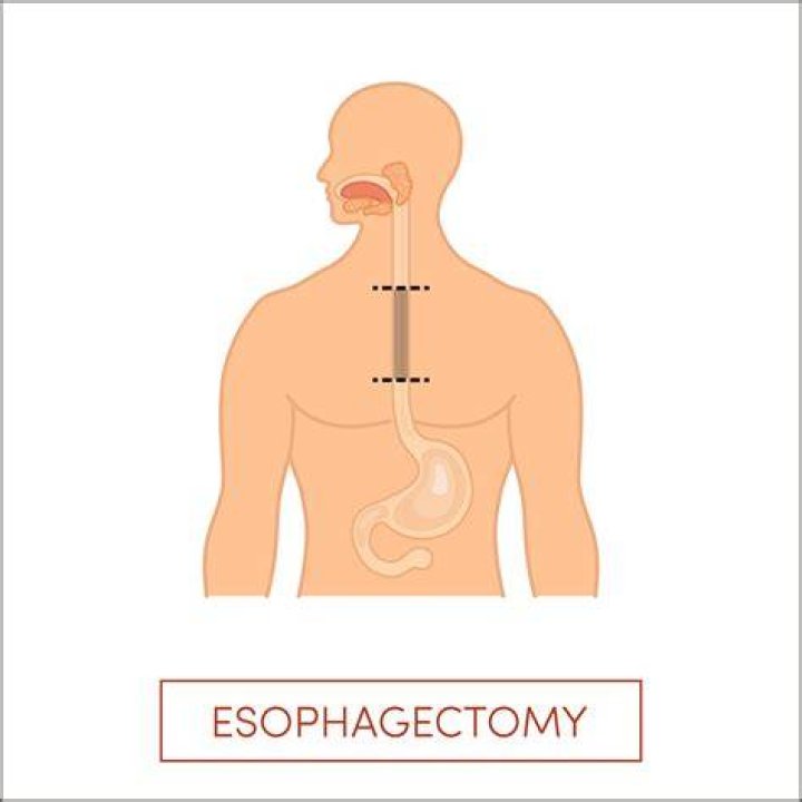 What is Esophagostomy
