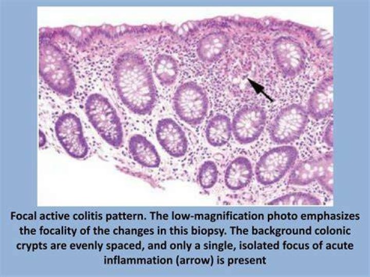 What is focal colitis