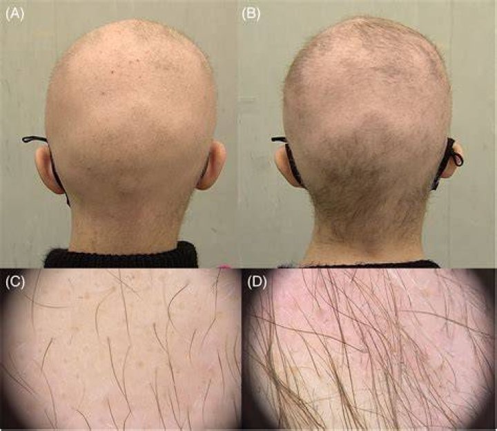 What is Hypotrichosis