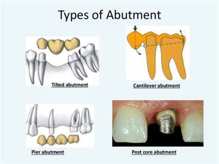 What is pier abutment
