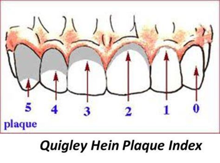 What is plaque index
