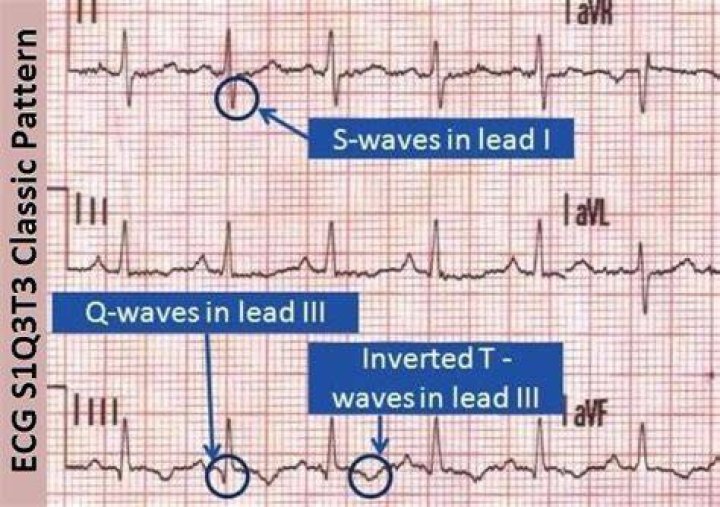 What is s1q3t3 in ECG