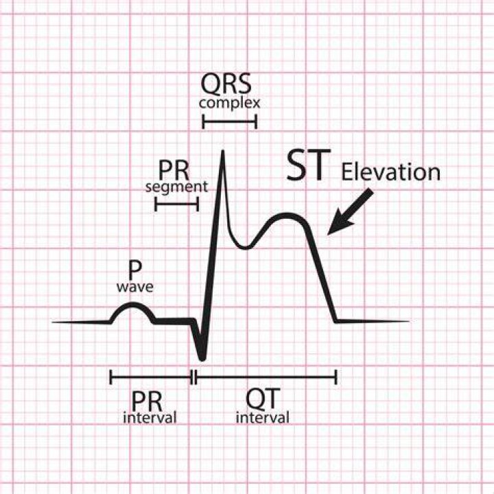 What is stemi in ACLS