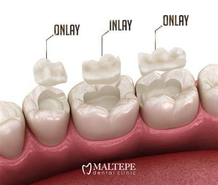 What is tooth overlay