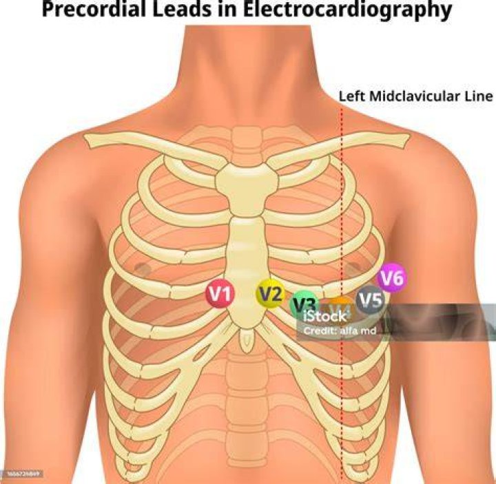 What is V1 V6 in ECG
