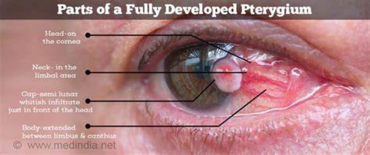 What pterygium means